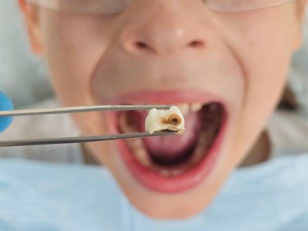 Best Emergency Dental Extractions in Dandridge, TN
